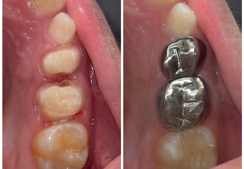 Chụp thép răng sữa cho bé - Tất cả những điều cần biết